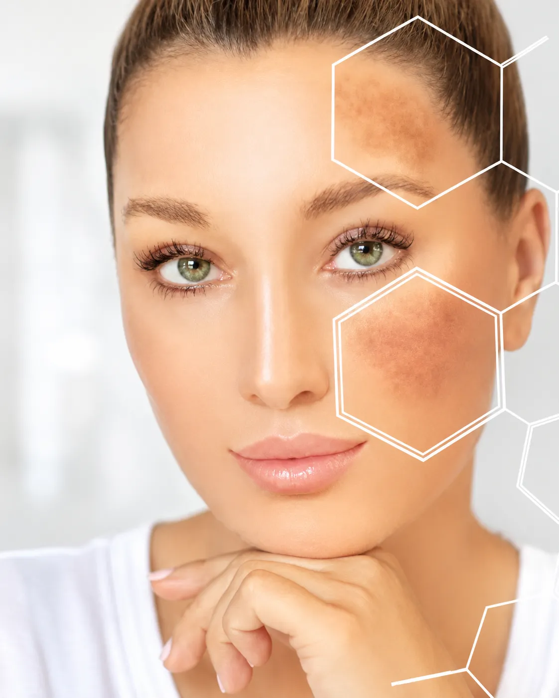 Hyper-Pigmentation & Melasma
