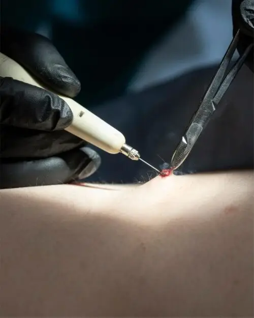 Moles & Skin Tag Removal