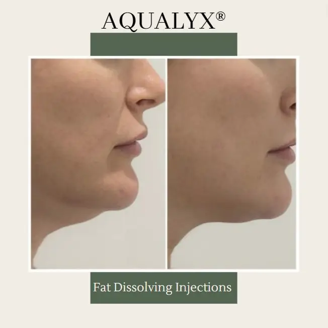 Aqualyx fat dissolving before and after