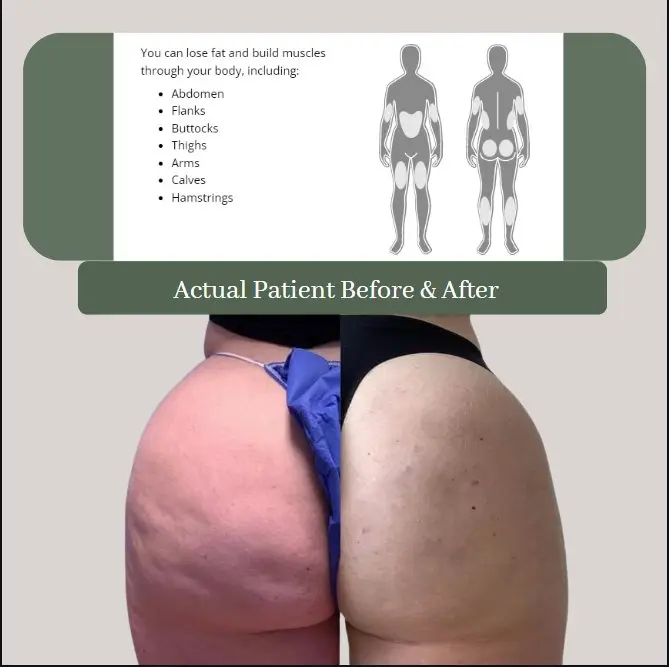 Body Sculpt HIFEM before and after