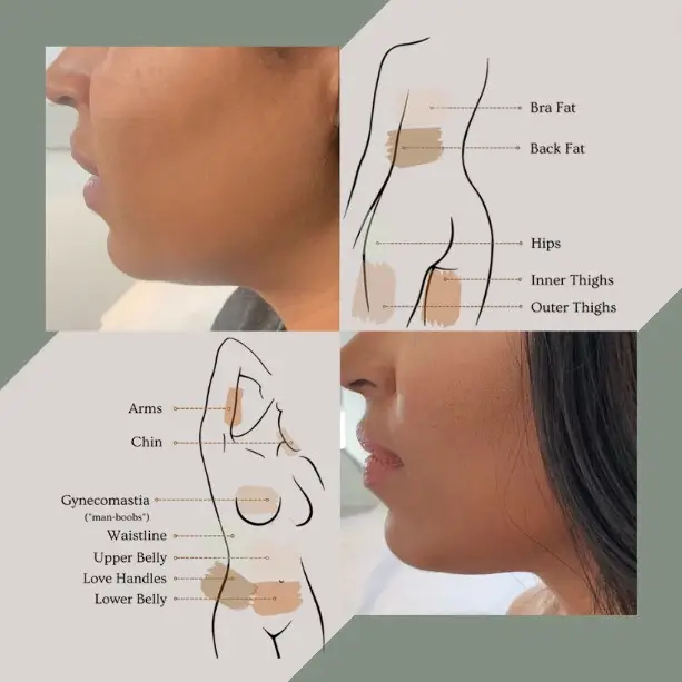 Aqualyx fat dissolving before and after