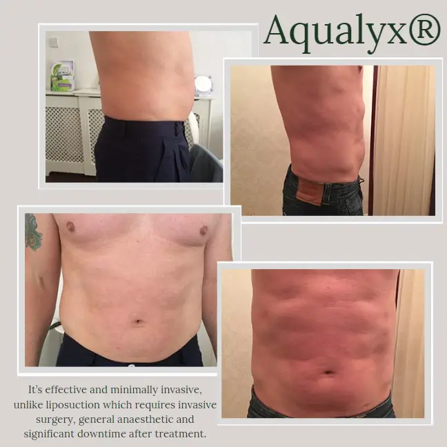 Aqualyx fat dissolving before and after