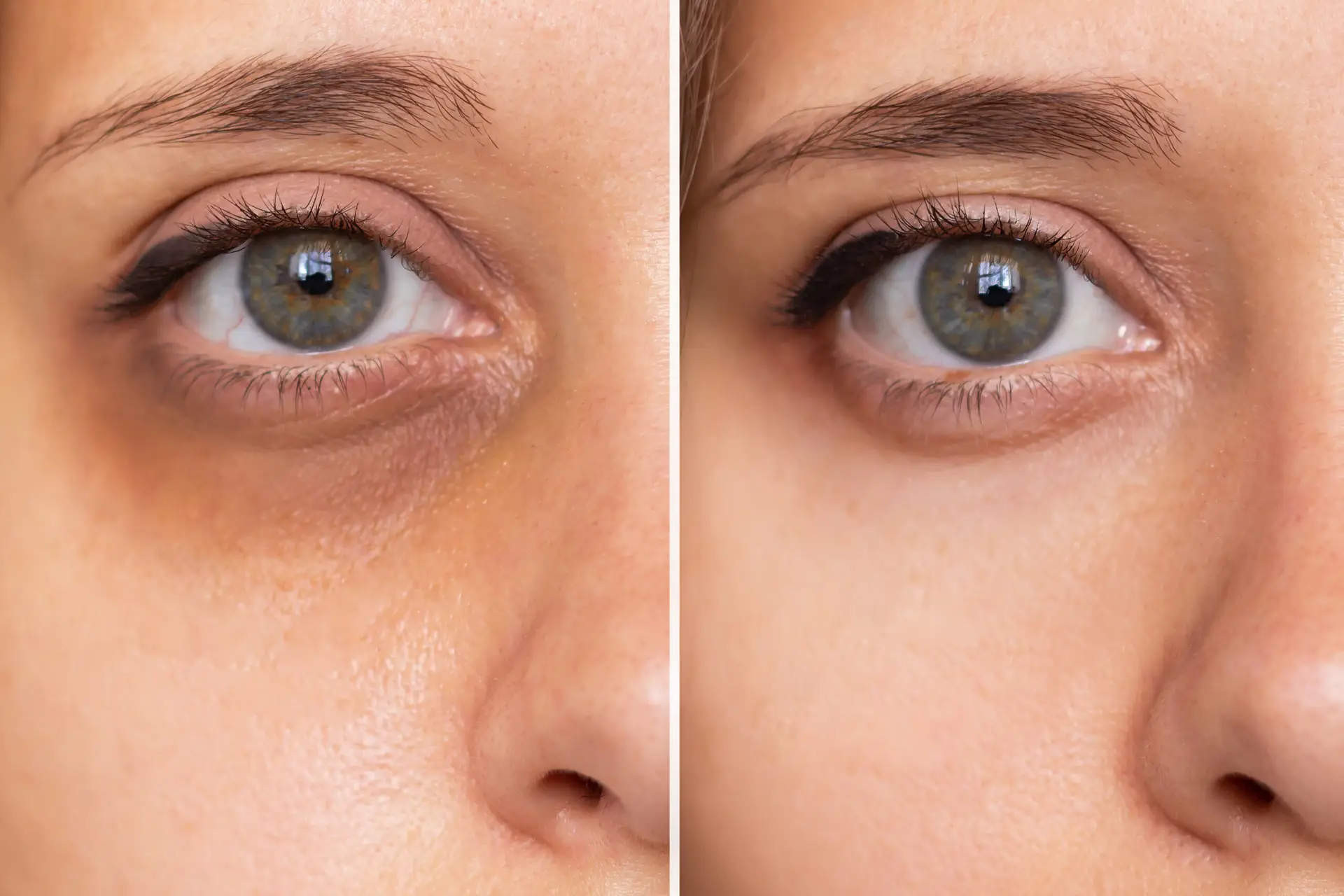 Under-eye dark circle treatment before and after result