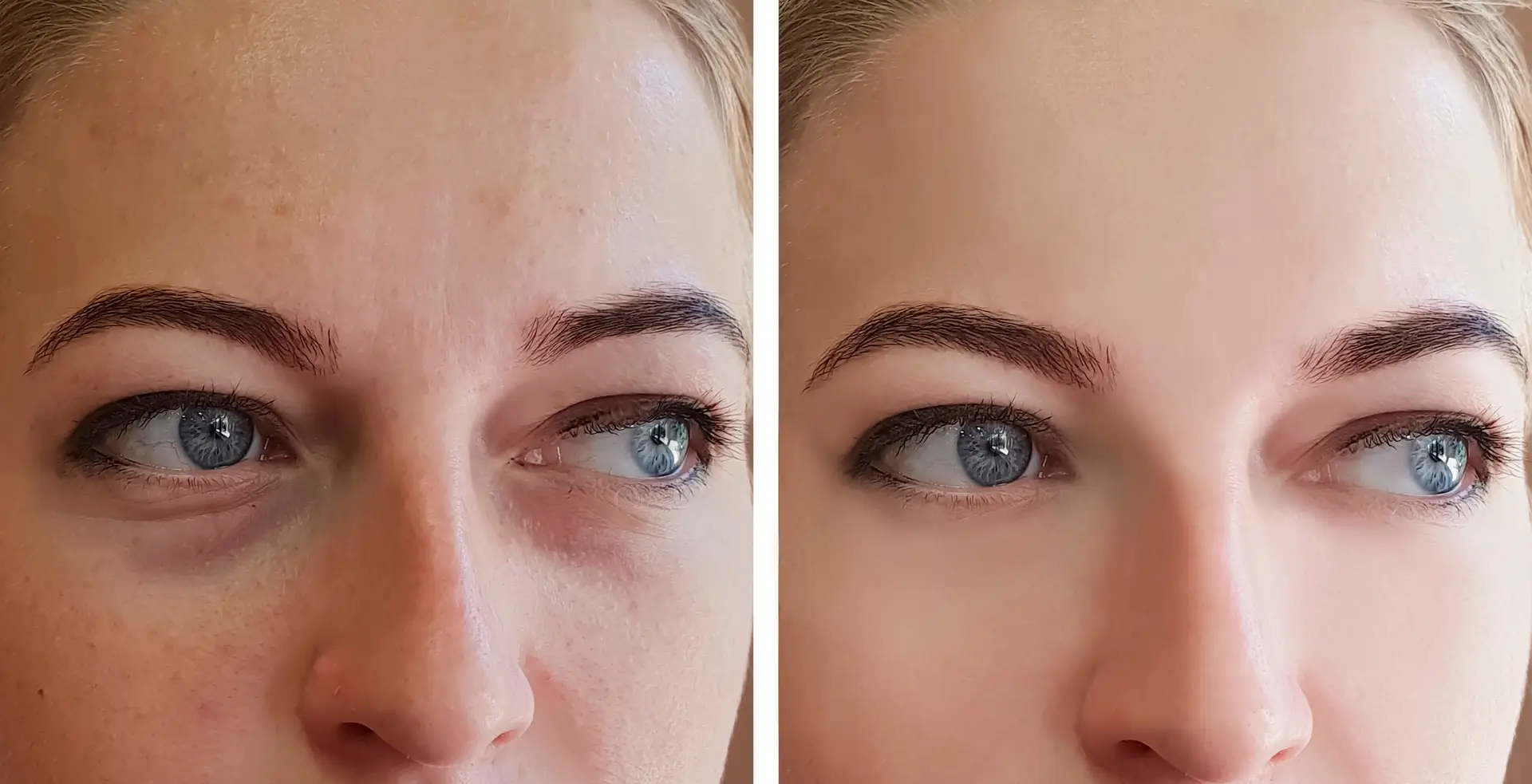Under-eye dark circle treatment before and after result