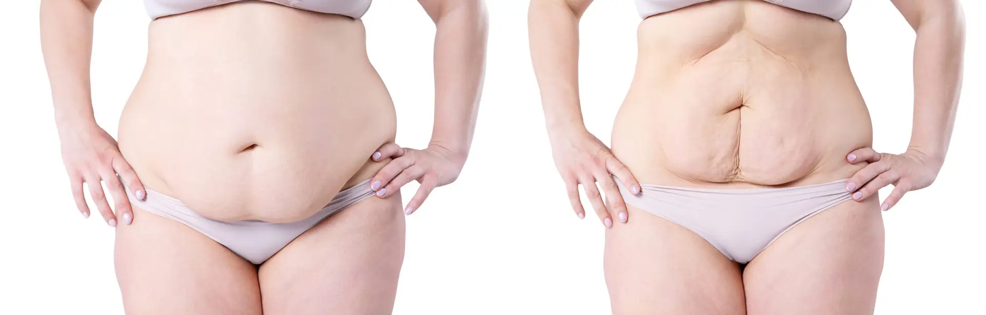 Body Sculpt HIFEM before and after result