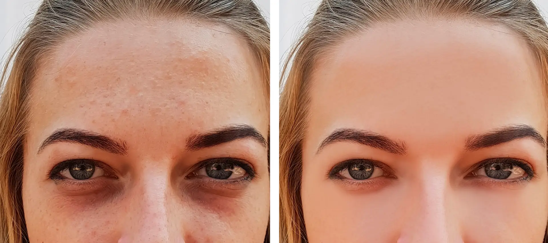 Under-eye dark circle treatment before and after result
