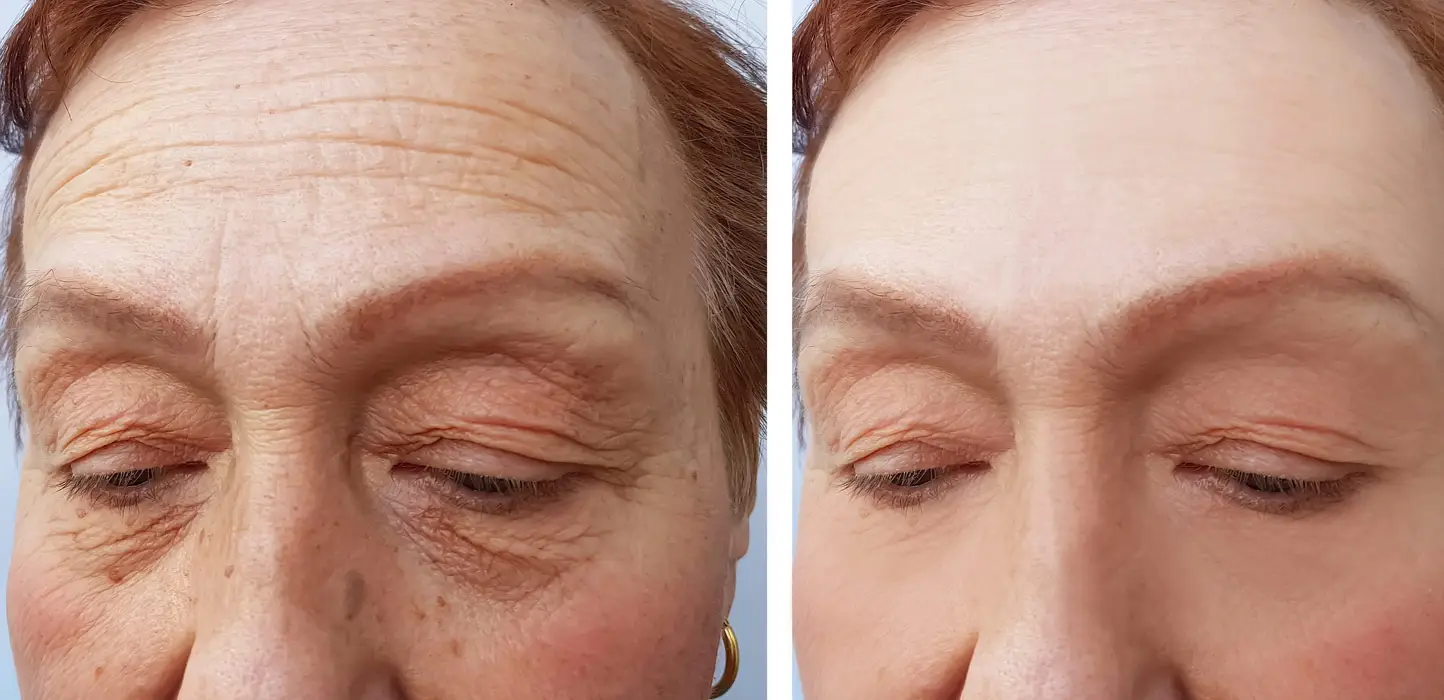 Botox before and after