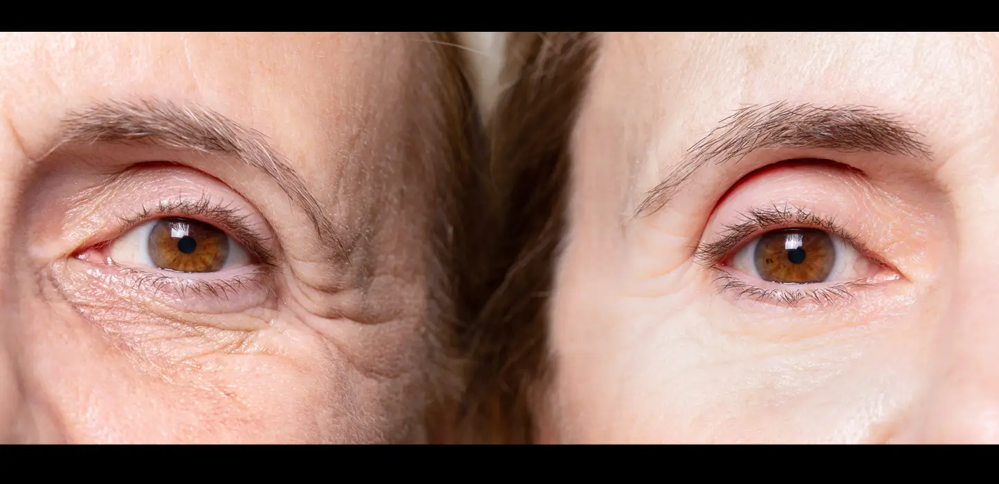 Botox before and after