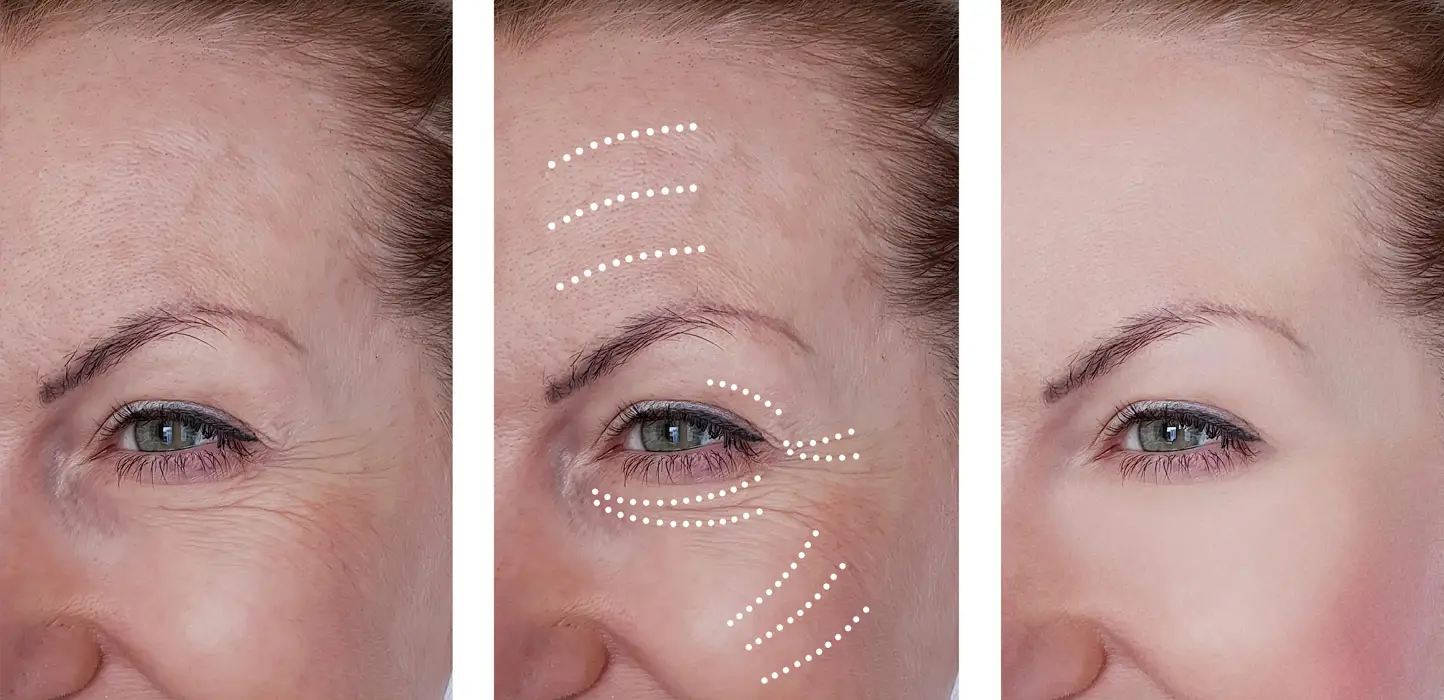 Botox before and after