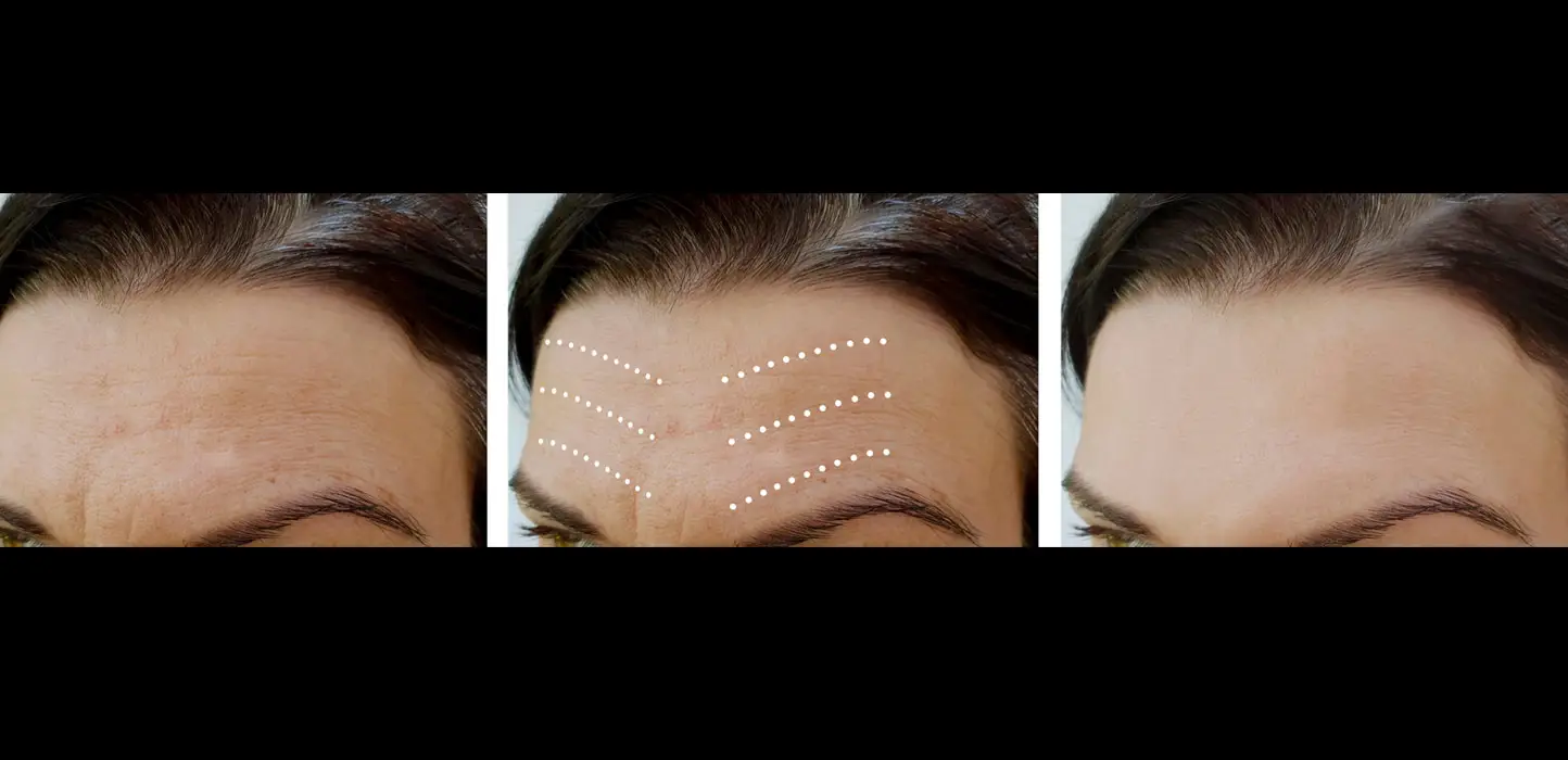 Botox before and after
