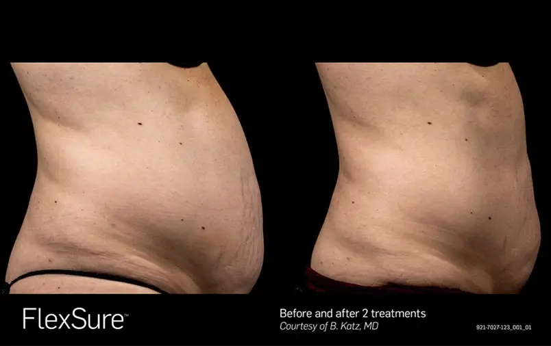 FlexSure body contouring before and after result