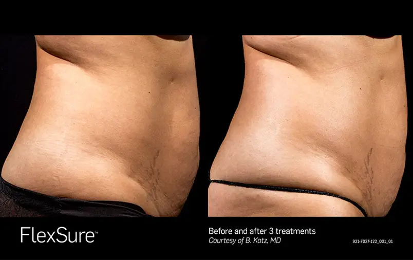 FlexSure body contouring before and after result
