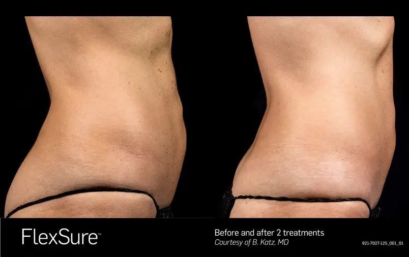 FlexSure body contouring before and after result