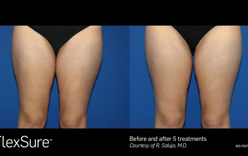 FlexSure body contouring before and after result