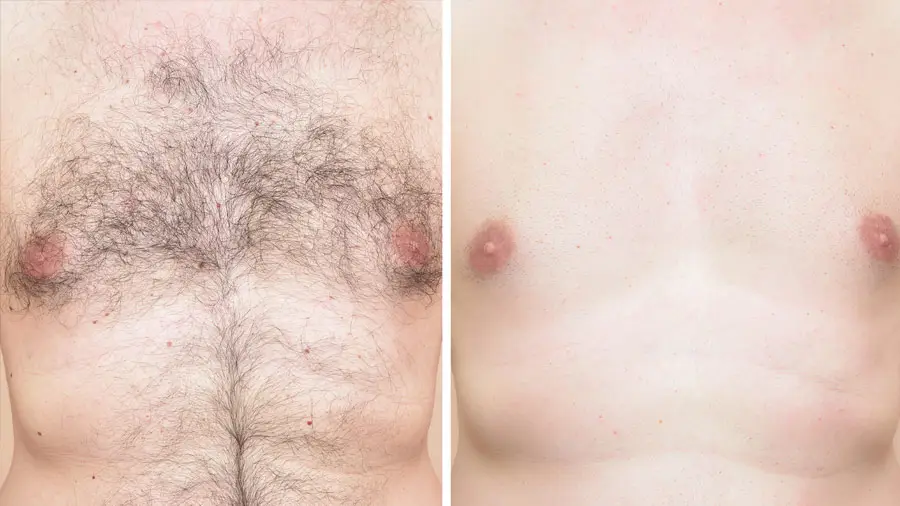 How to Choose the Right Permanent Hair Removal Clinic in Calgary