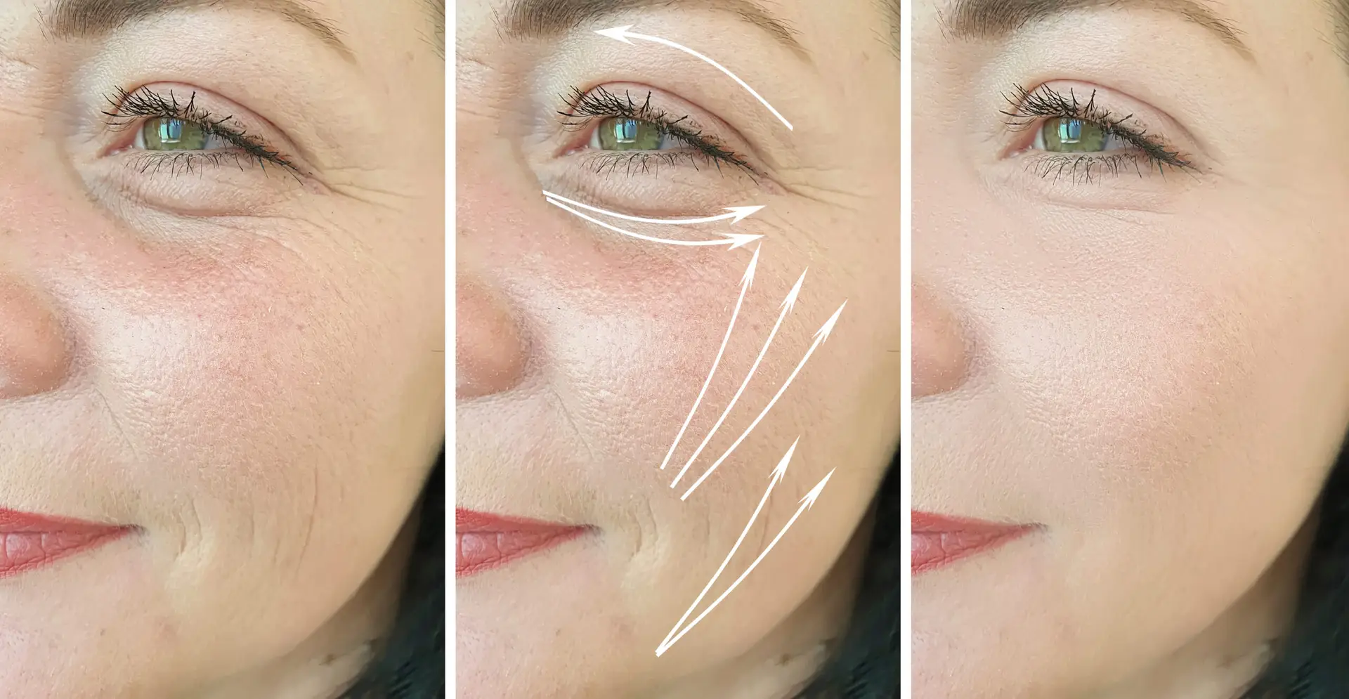 Profhilo before and after