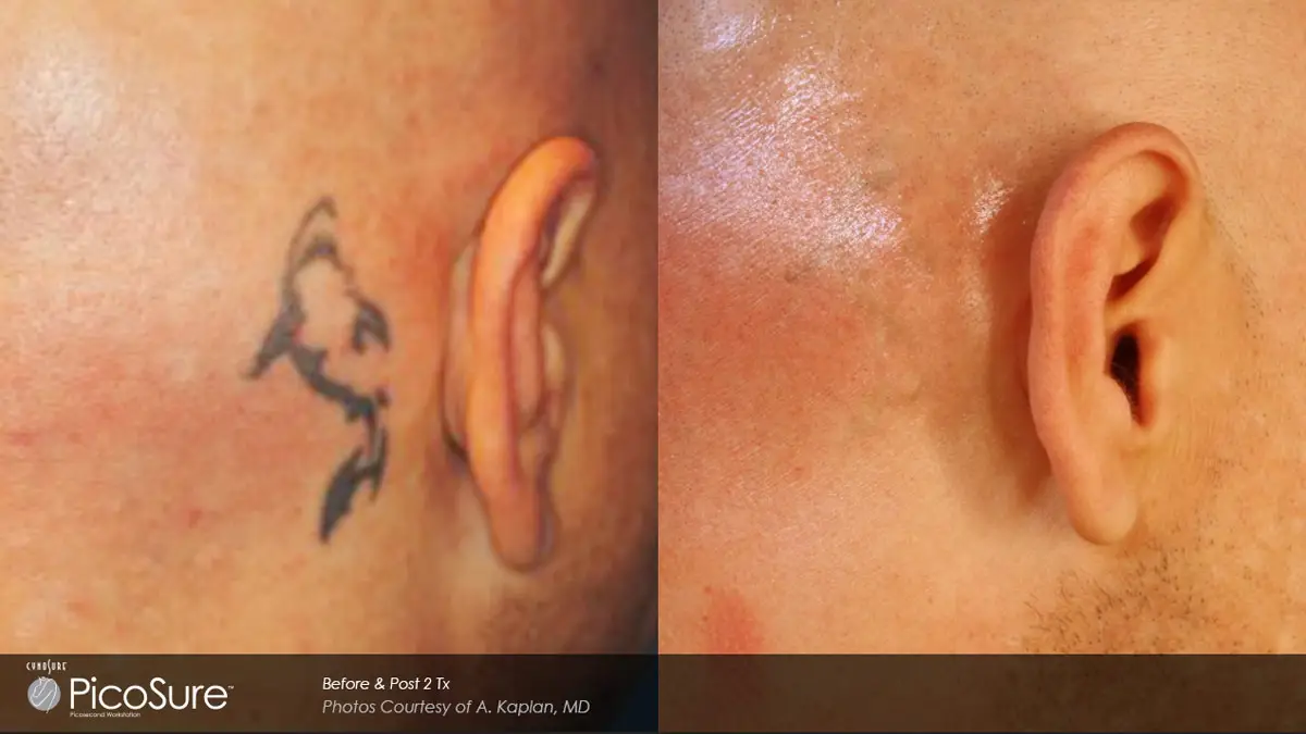 Tattoo removal before and after result