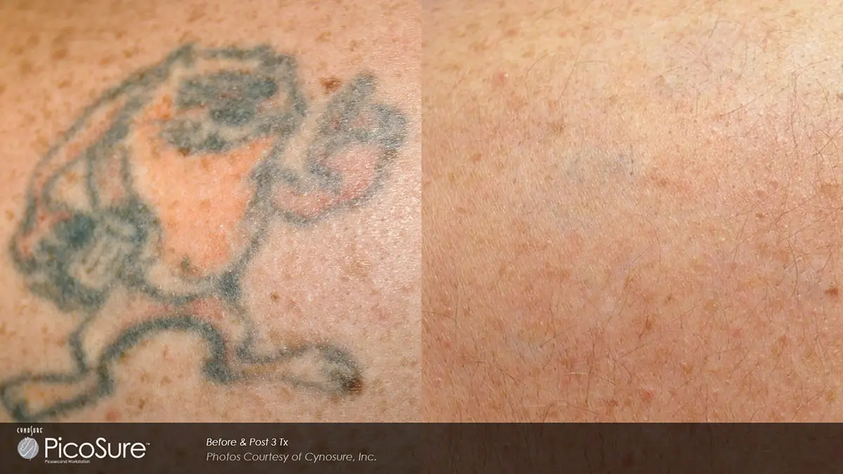 Tattoo removal before and after result