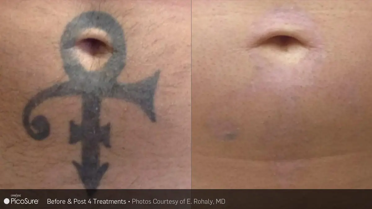 Tattoo removal before and after result