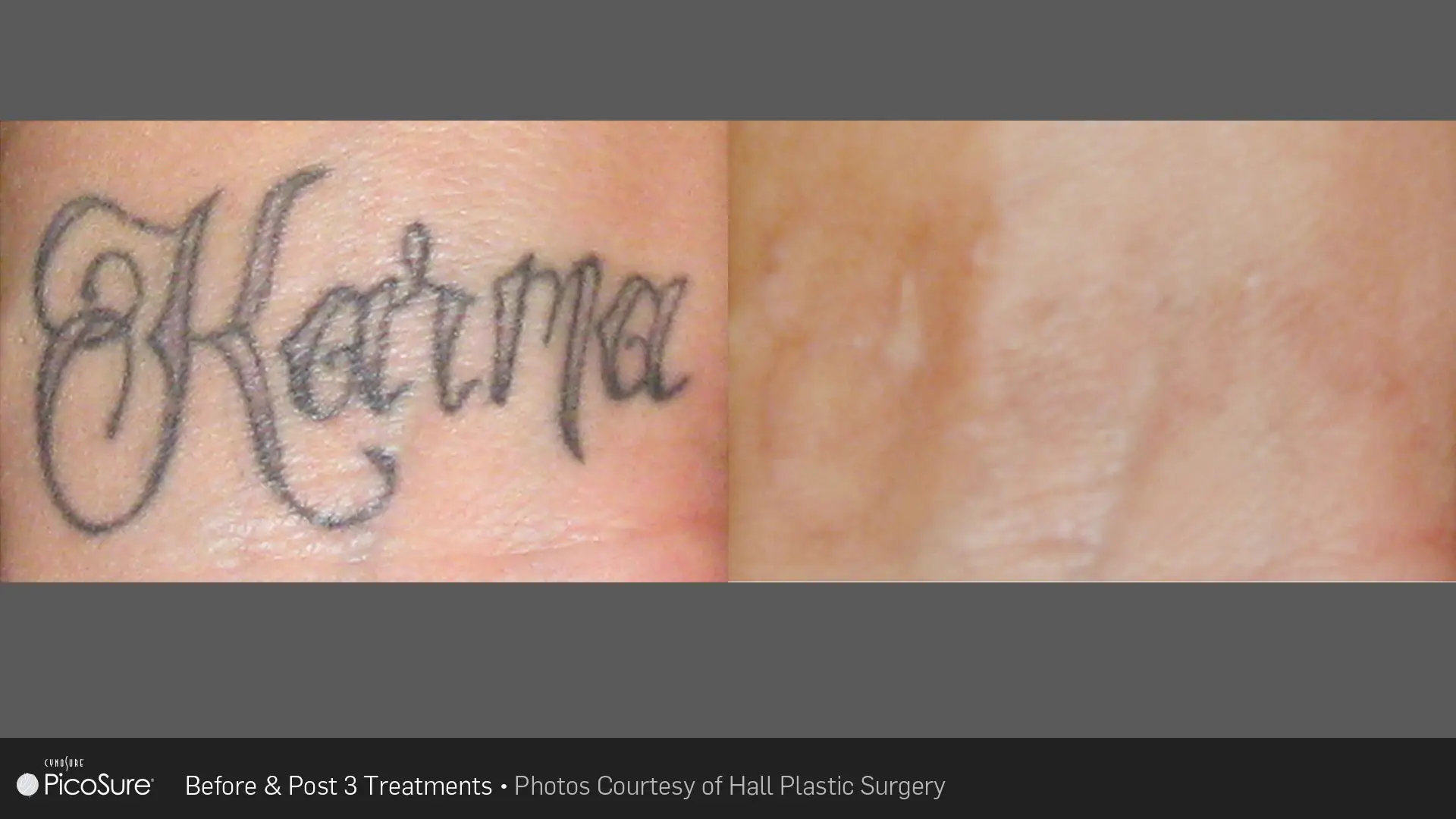 Tattoo removal before and after result