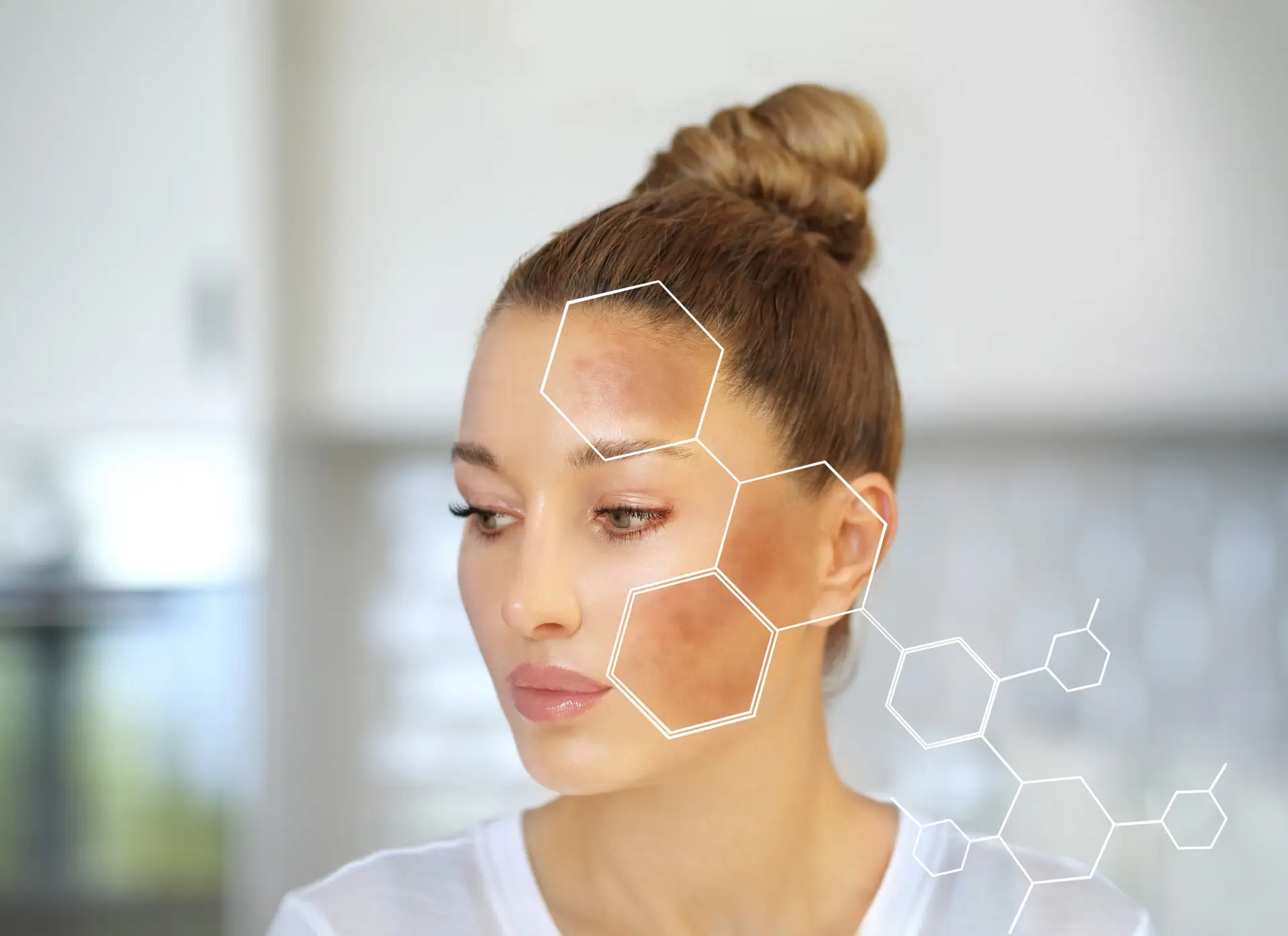 Unlocking the Secrets of Melasma Treatment and Brown Spot Removal