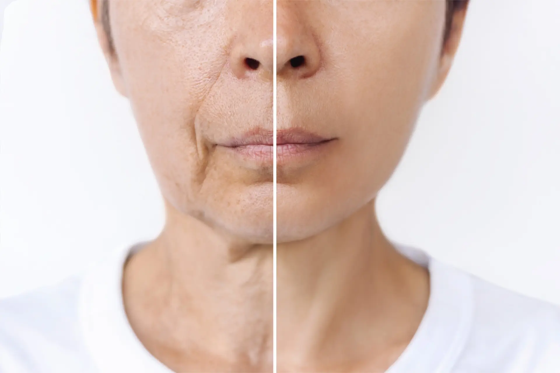 Everything You Need to Know About Radiesse Dermal Filler