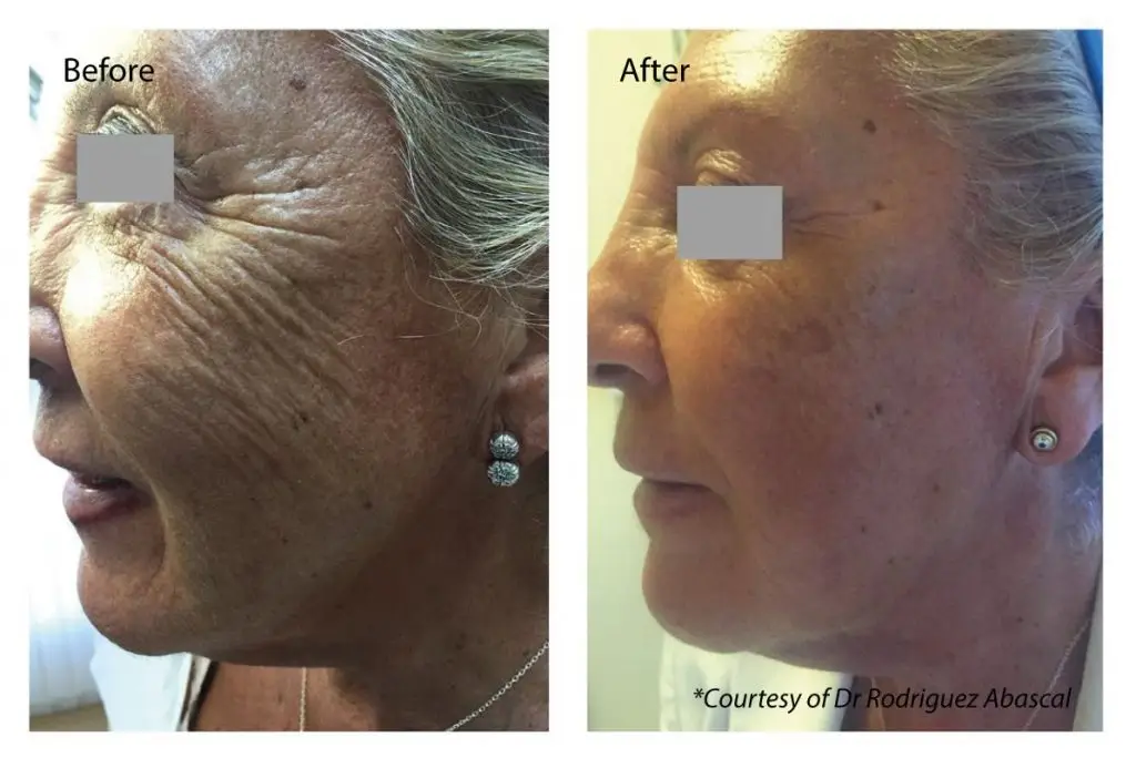 Profhilo before and after