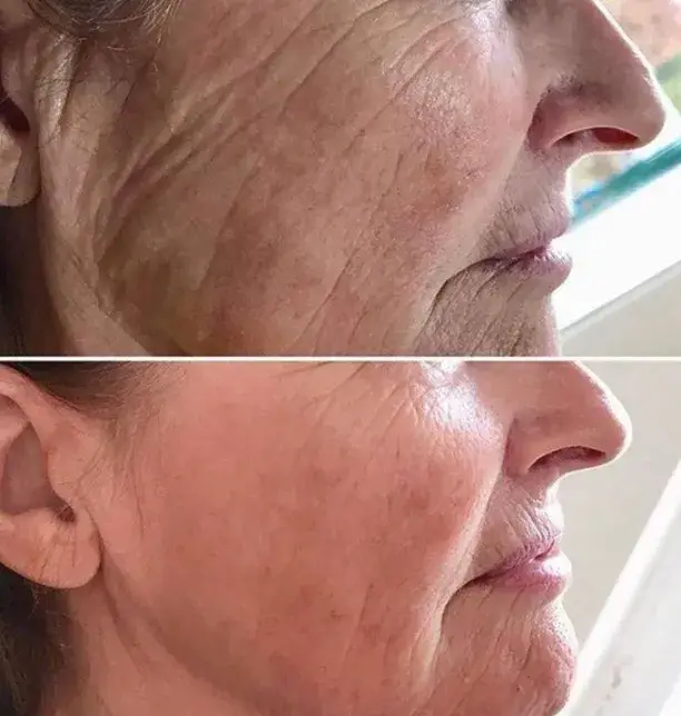 Profhilo before and after