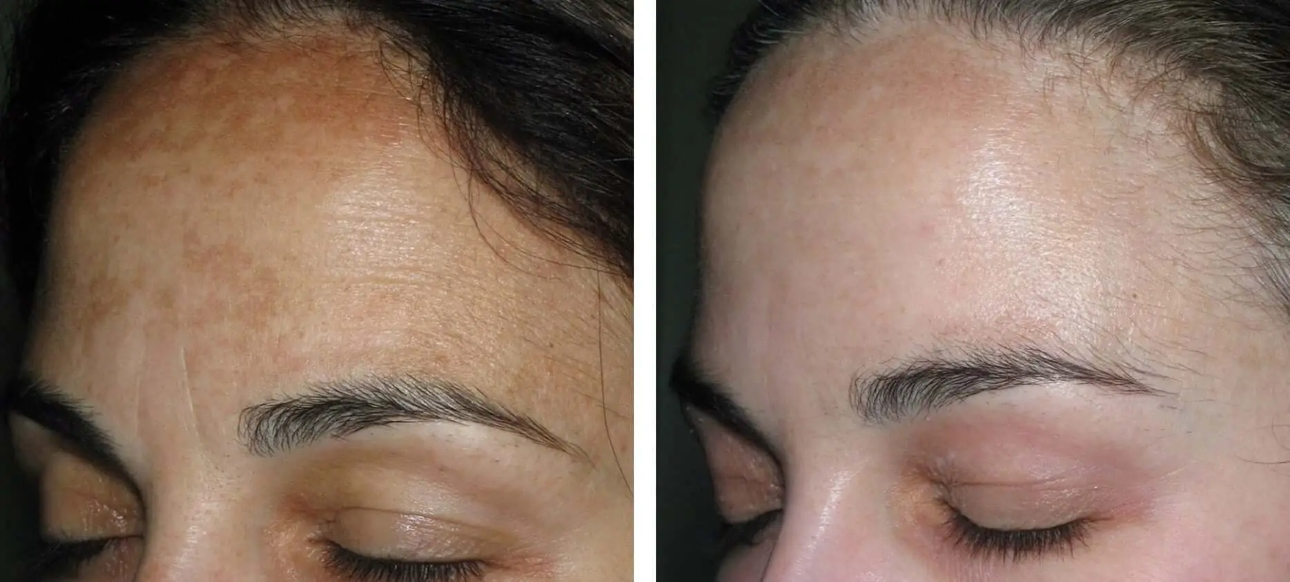 Pigmentation before and after result