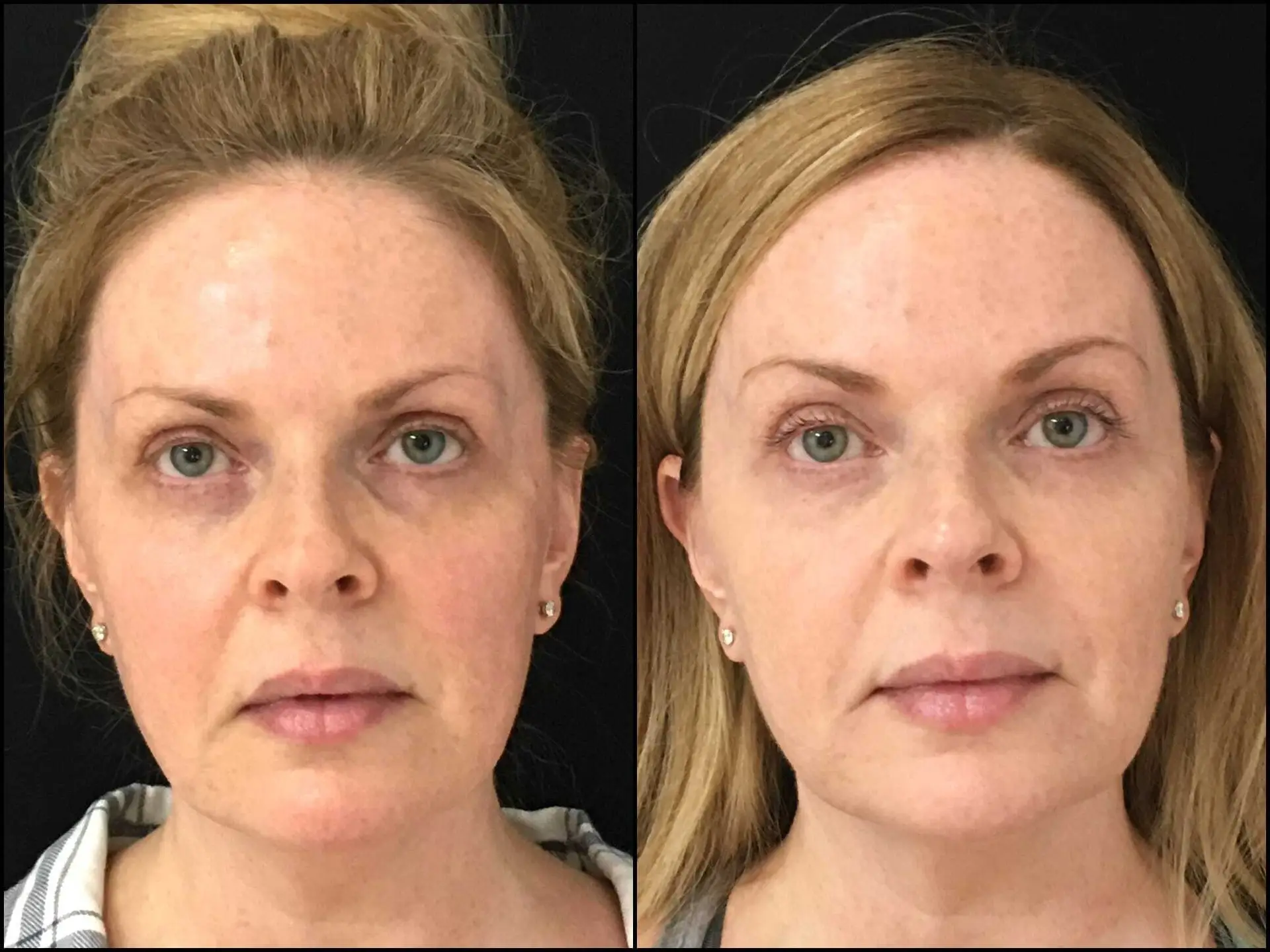 Dermal fillers before and after