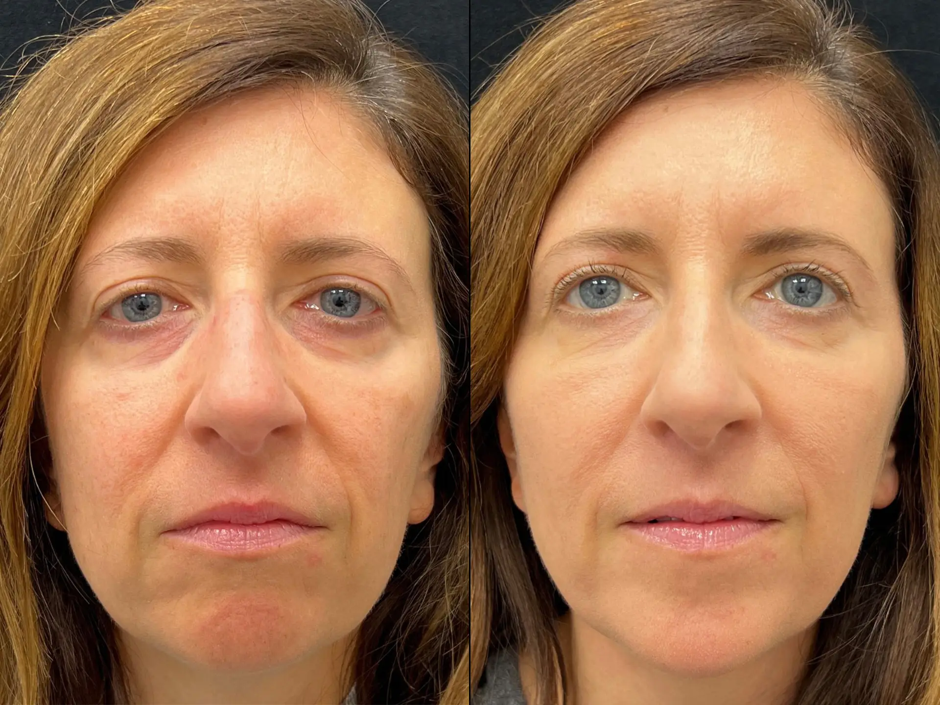 Dermal fillers before and after