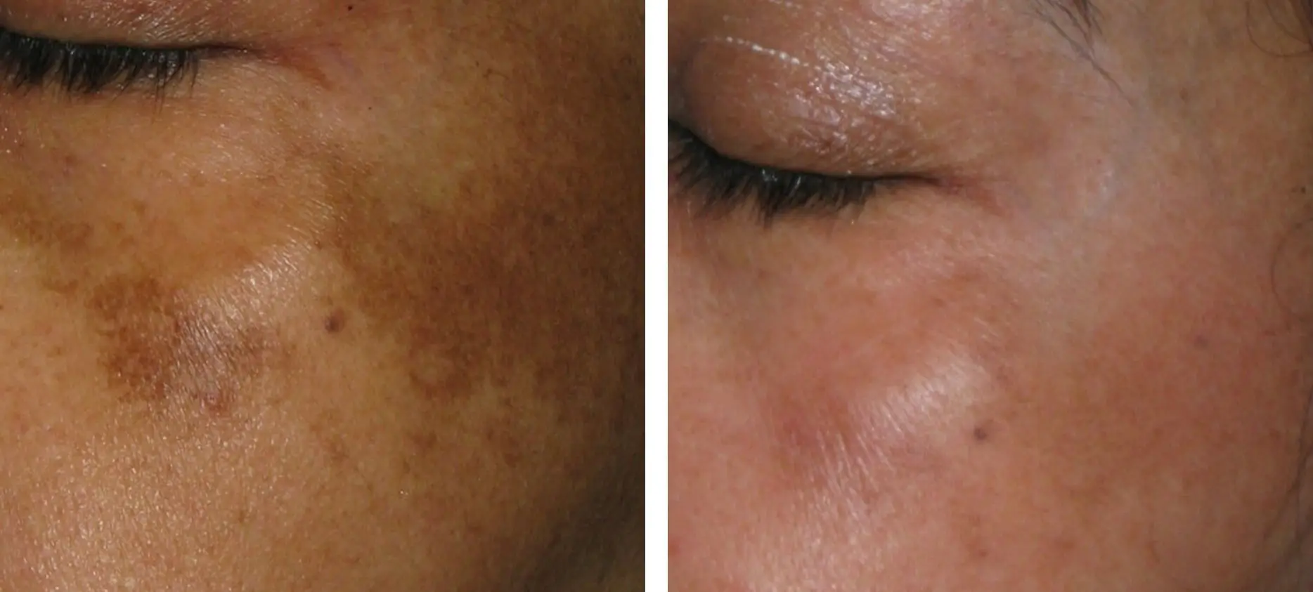 Pigmentation before and after result
