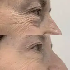 Ligament lift before and after