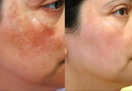 Pigmentation before and after result