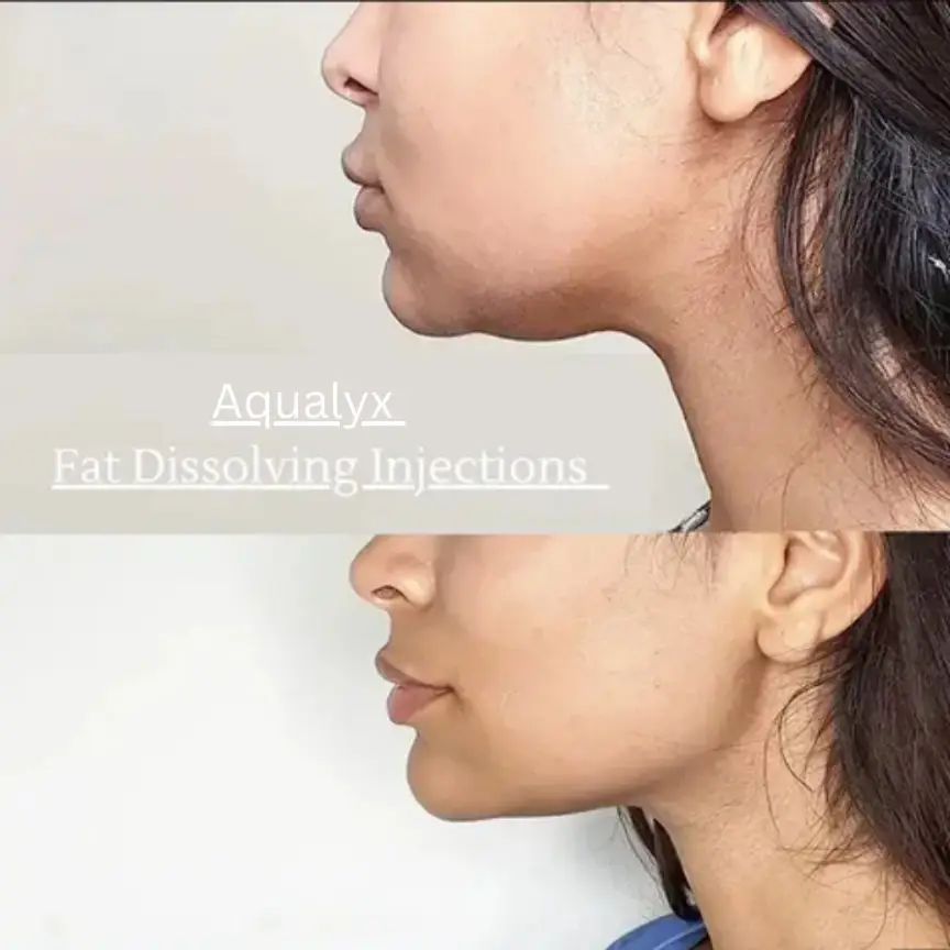 Aqualyx fat dissolving before and after
