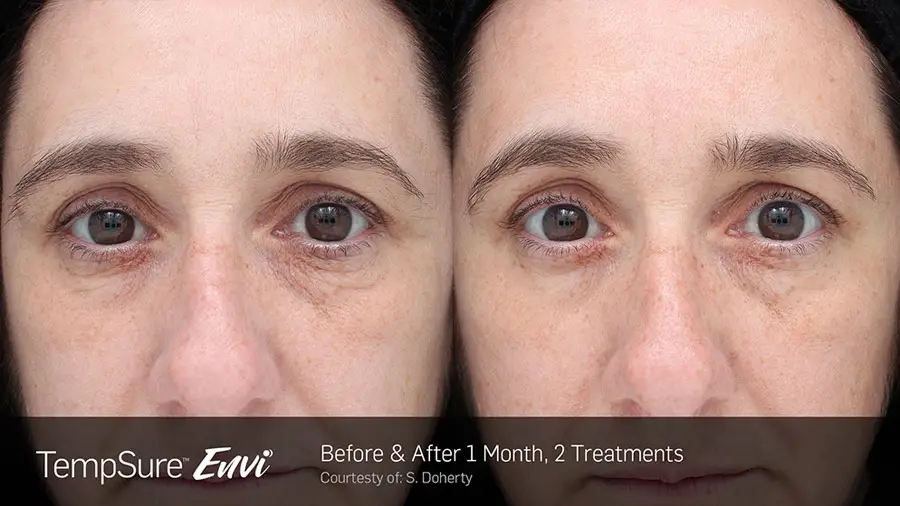 TempSure Envi skin tightening before and after result