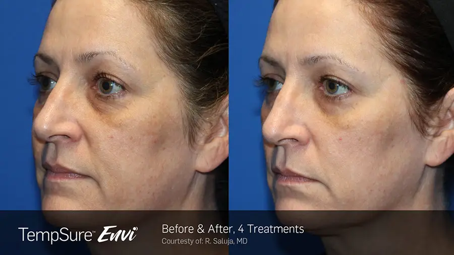 TempSure Envi skin tightening before and after result