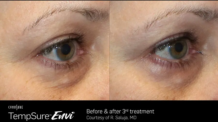 TempSure Envi skin tightening before and after result