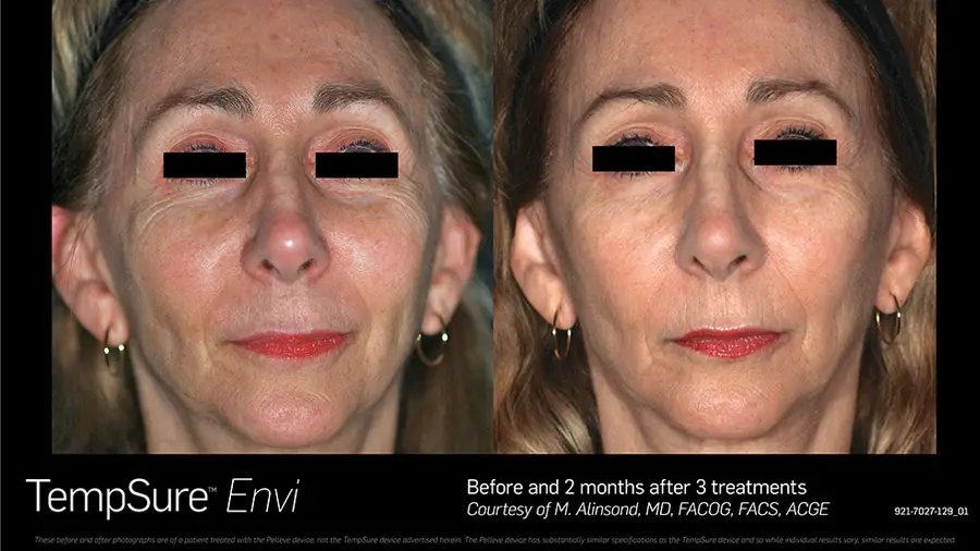 TempSure Envi skin tightening before and after result
