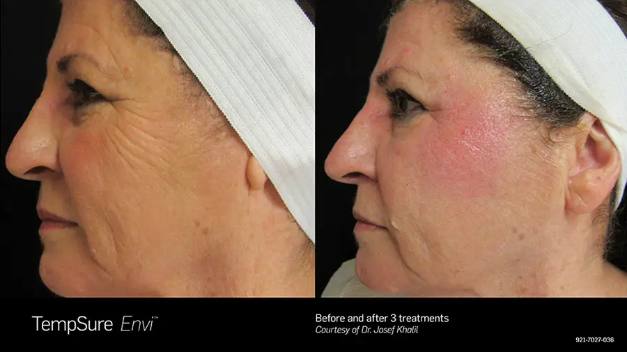 TempSure Envi skin tightening before and after result
