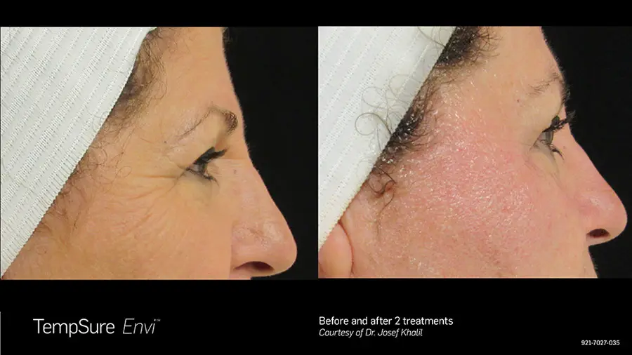 TempSure Envi skin tightening before and after result