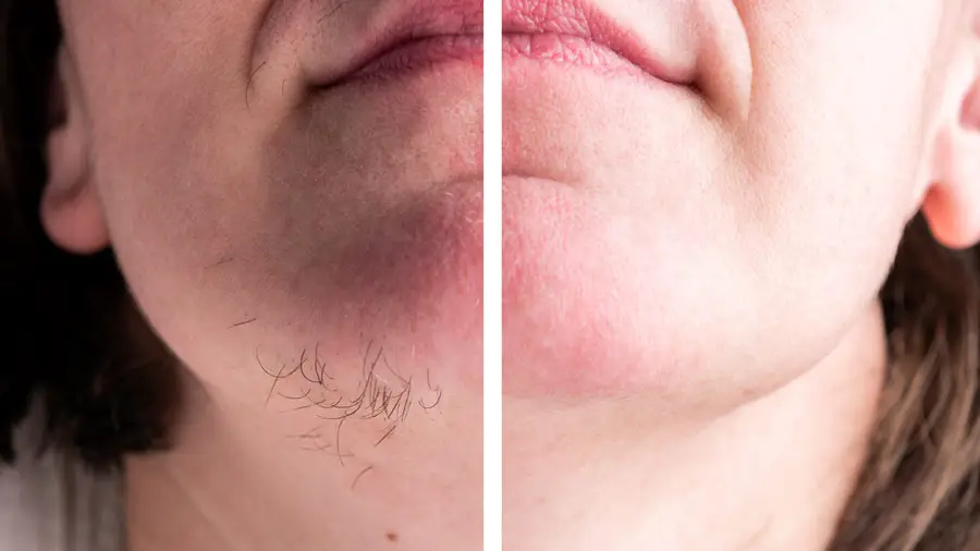 Laser hair removal before and after result