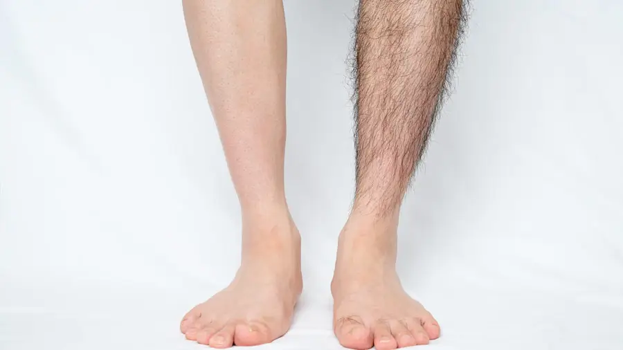 Laser hair removal before and after result