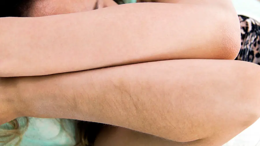 Laser hair removal before and after result