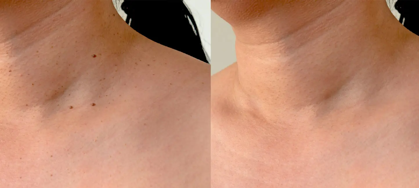 Mole and skin tag removal before and after