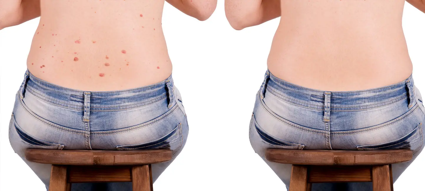 Mole and skin tag removal before and after