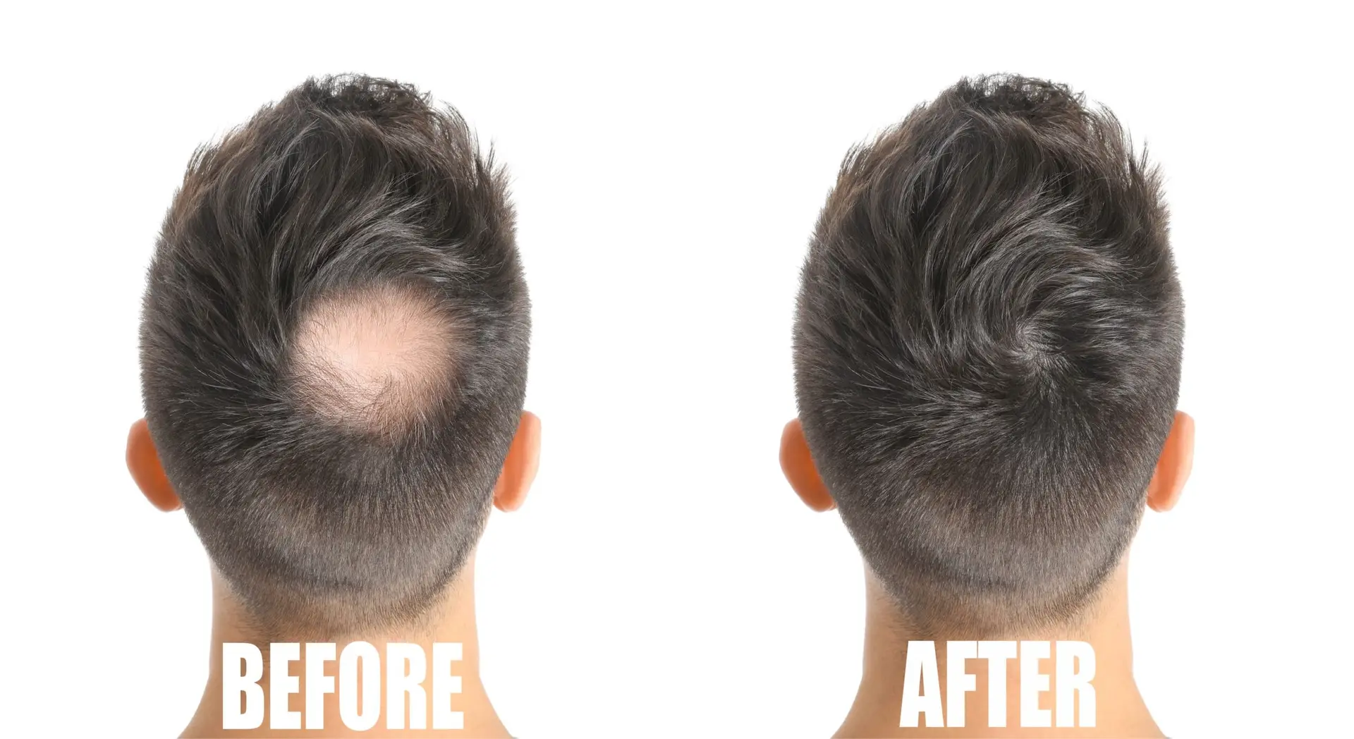 Hair restoration before and after