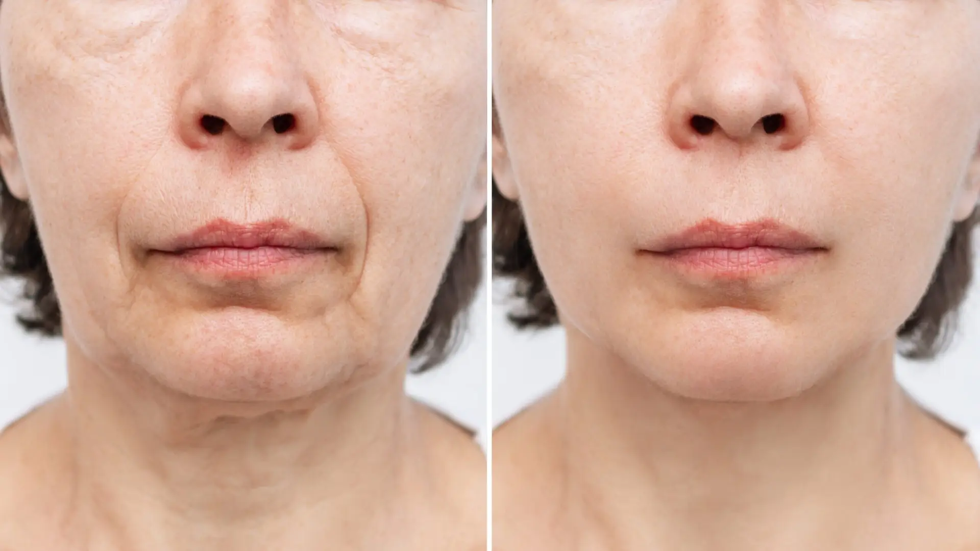 Radiesse before and after