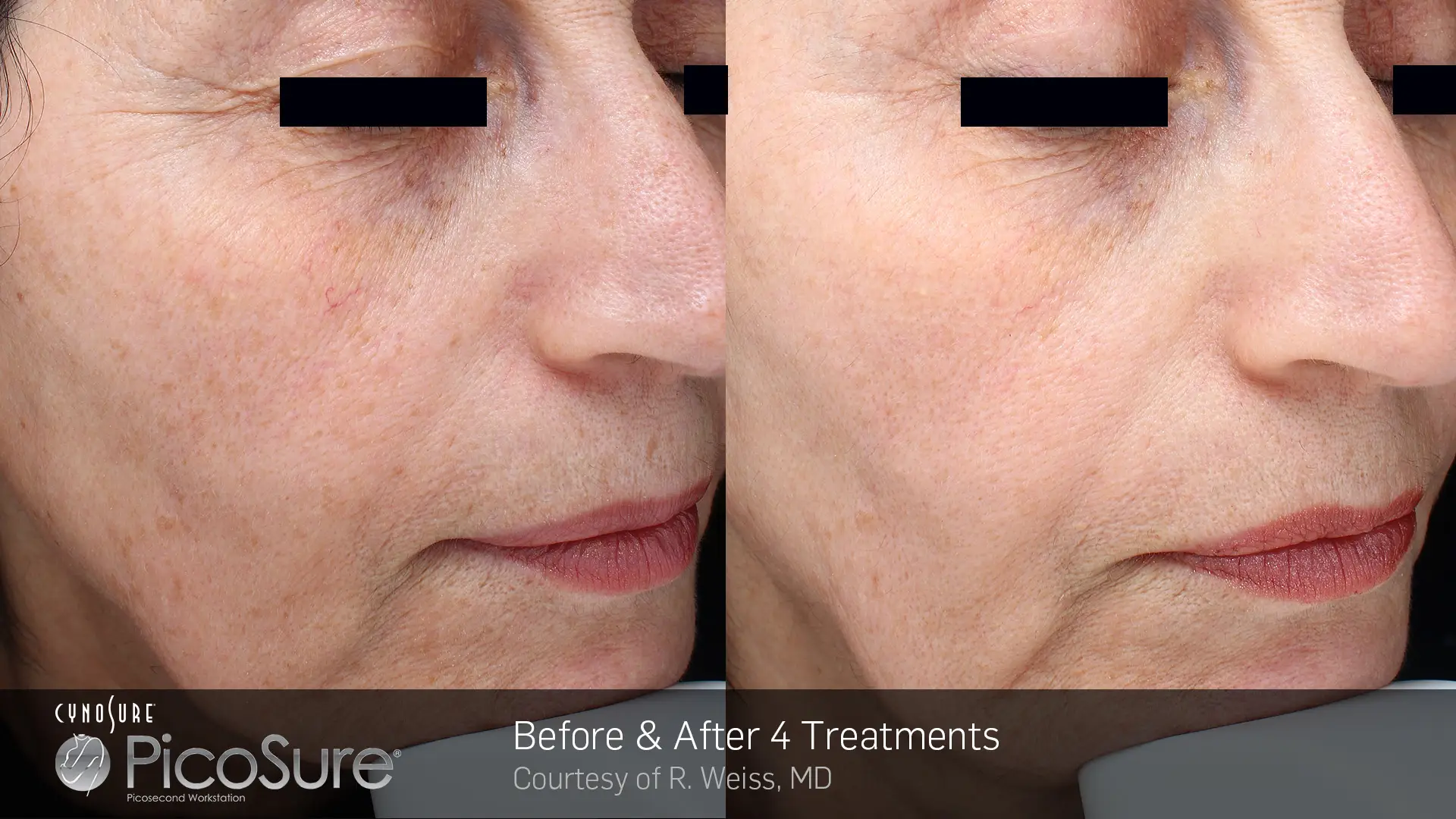 PicoSure before and after result