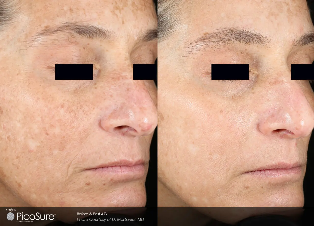 PicoSure before and after result